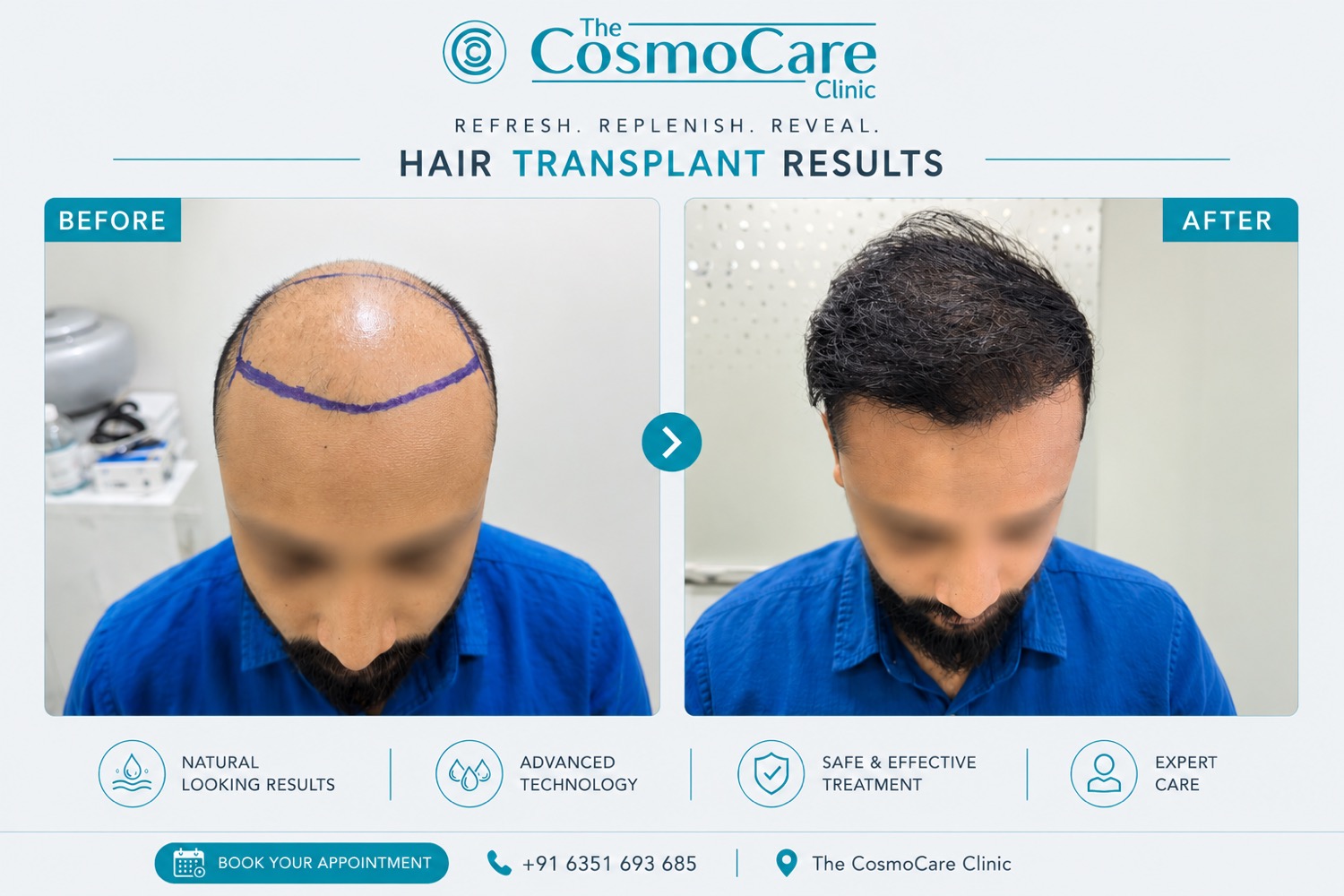 Real hair transplant before and after at CosmoCare Vapi