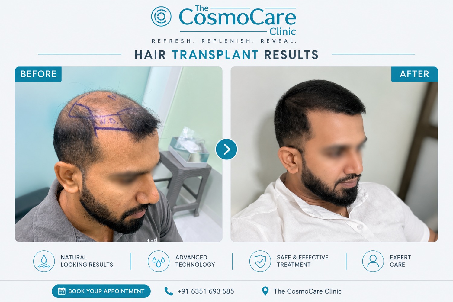 Hair transplant transformation at CosmoCare Vapi