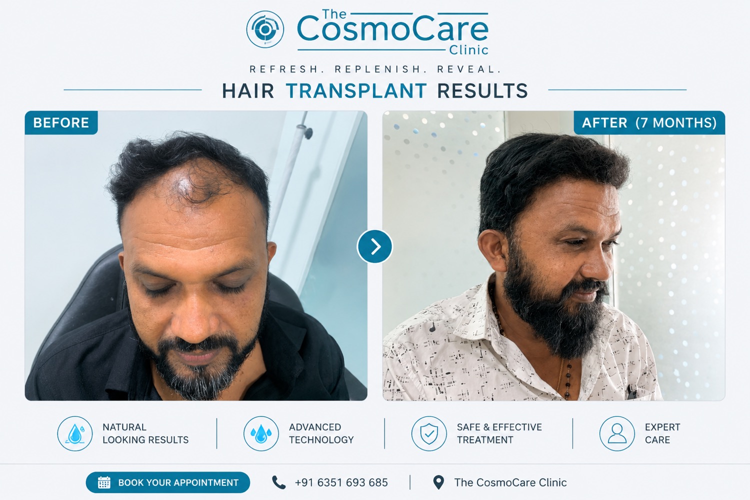 Complete baldness reversal hair transplant — CosmoCare Vapi