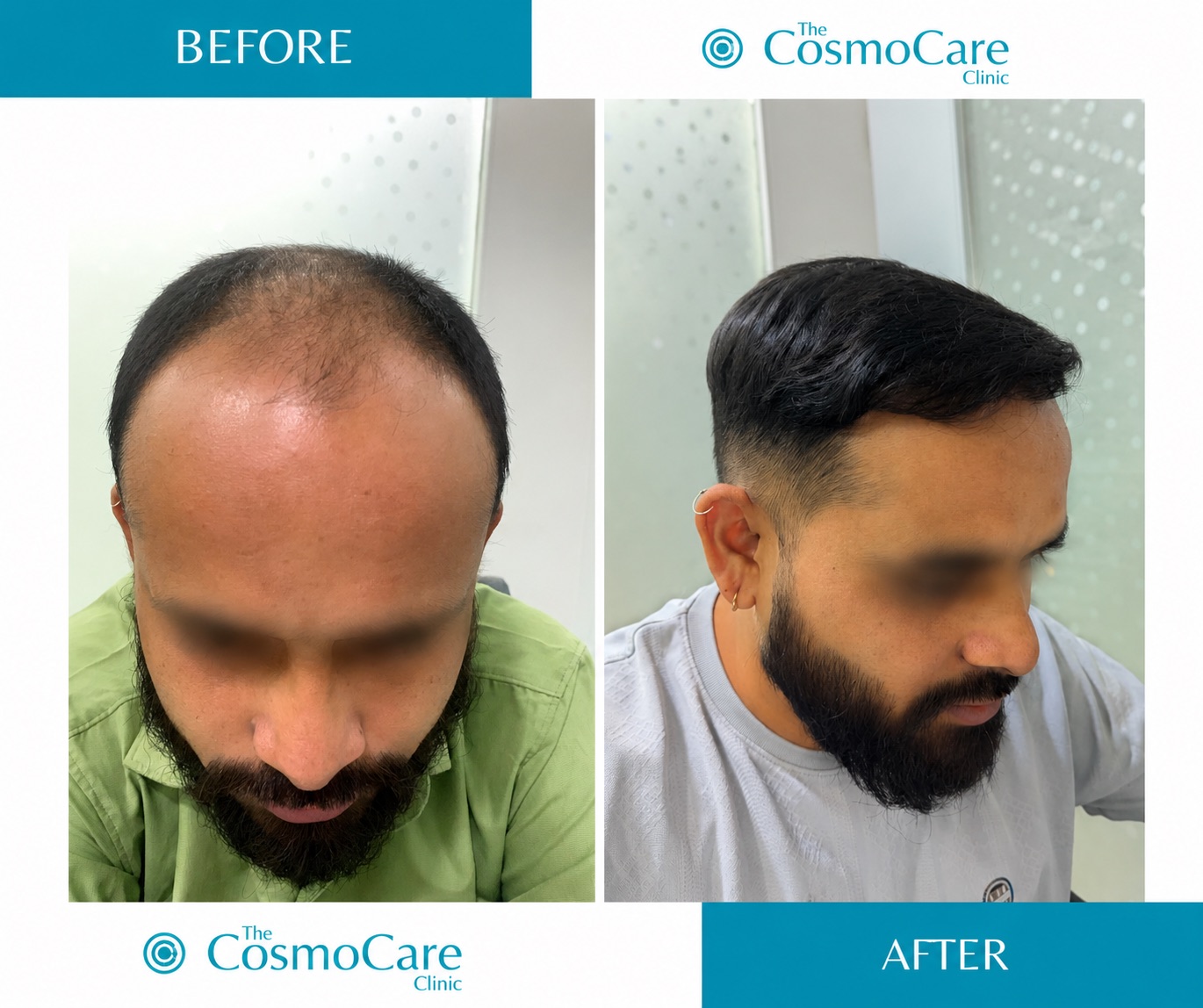 Hair transplant before and after — restored hairline at The CosmoCare Clinic, Vapi