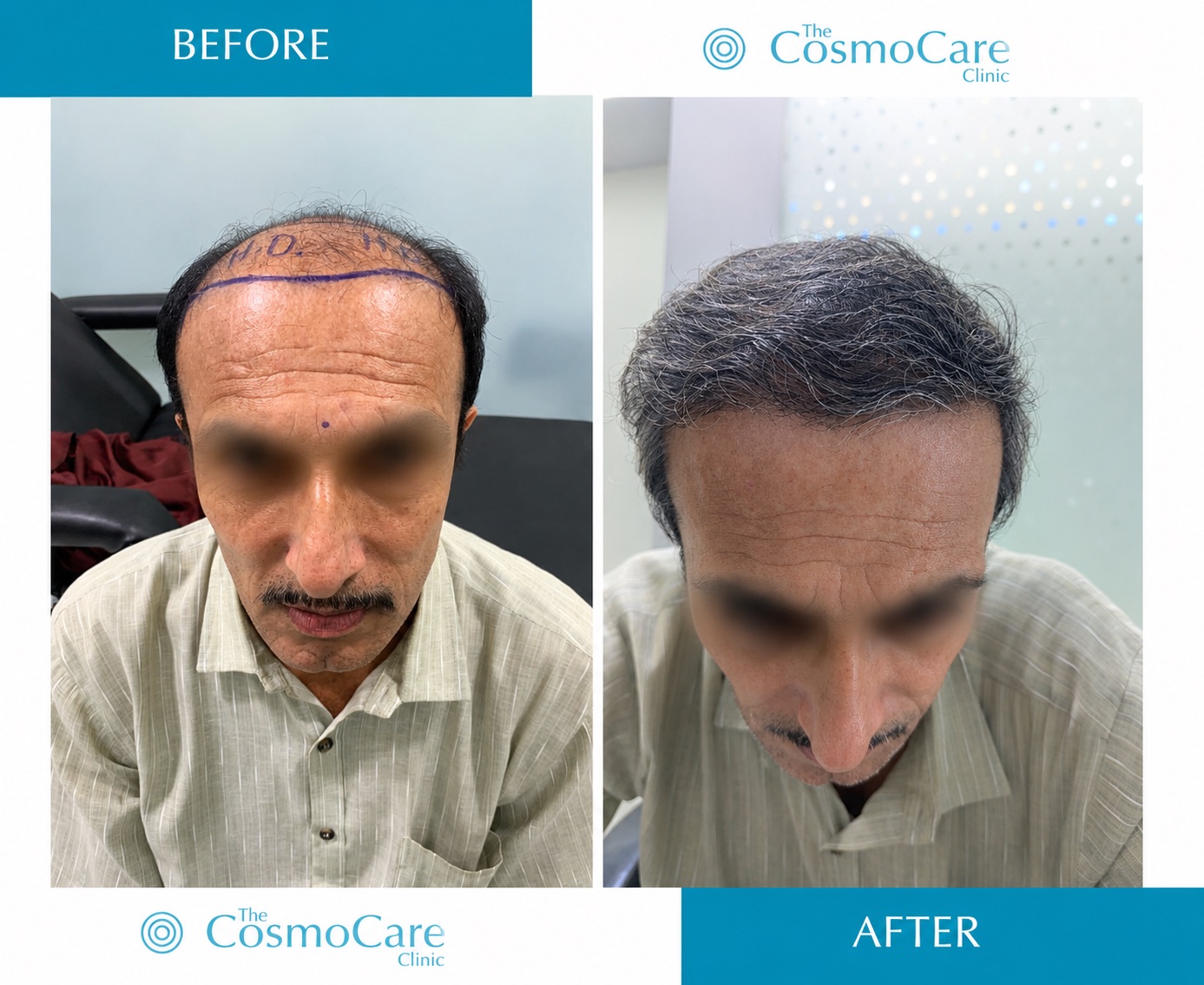 Hair transplant before and after result at The CosmoCare Clinic, Vapi